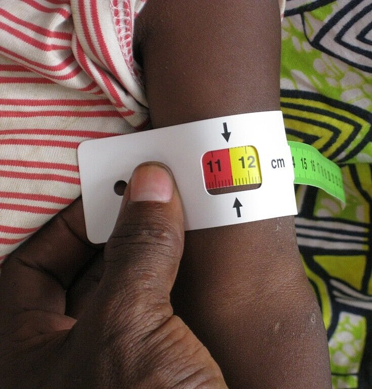 An einem Kinderarm wird mit einem Maßband gemessen, ob es unterernährt ist