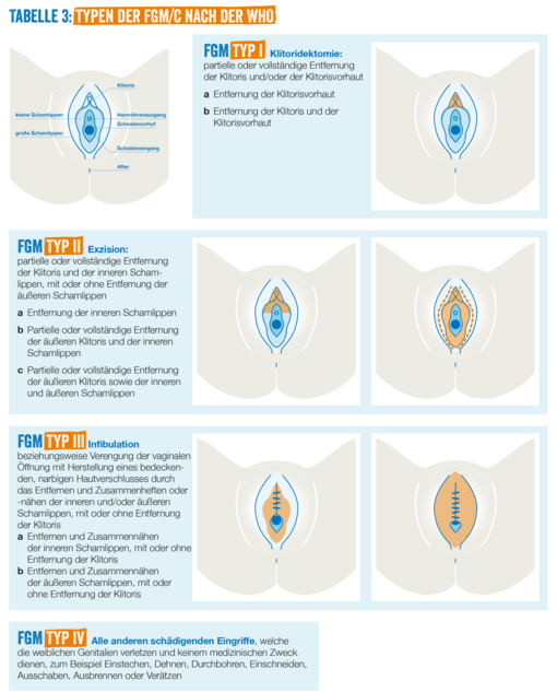Grafik, die über die verschiedenen Stufen der weiblichen Genitalverstümmelung aufklärt